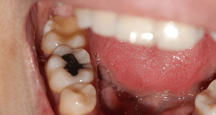 How Long Until A Tooth Infection Kills You Understanding Tooth Infections