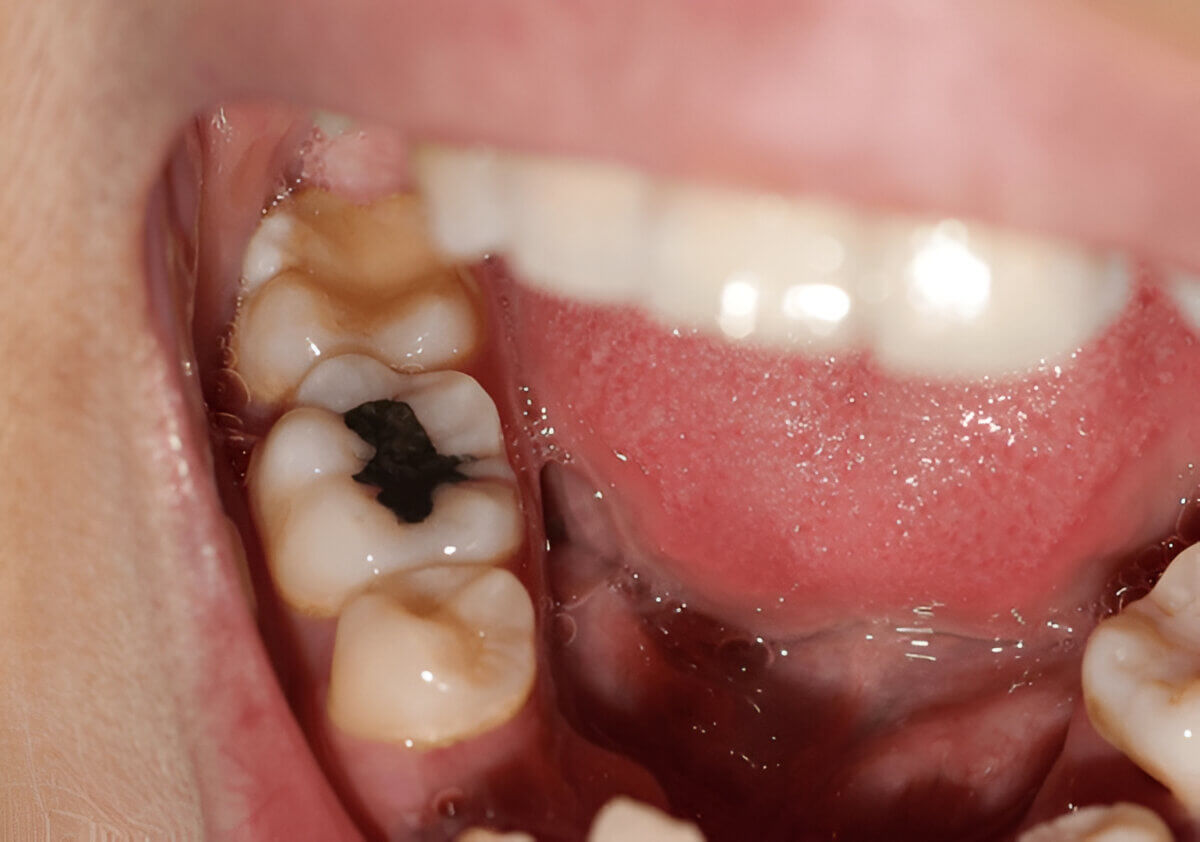 How Long Until A Tooth Infection Kills You Understanding Tooth Infections