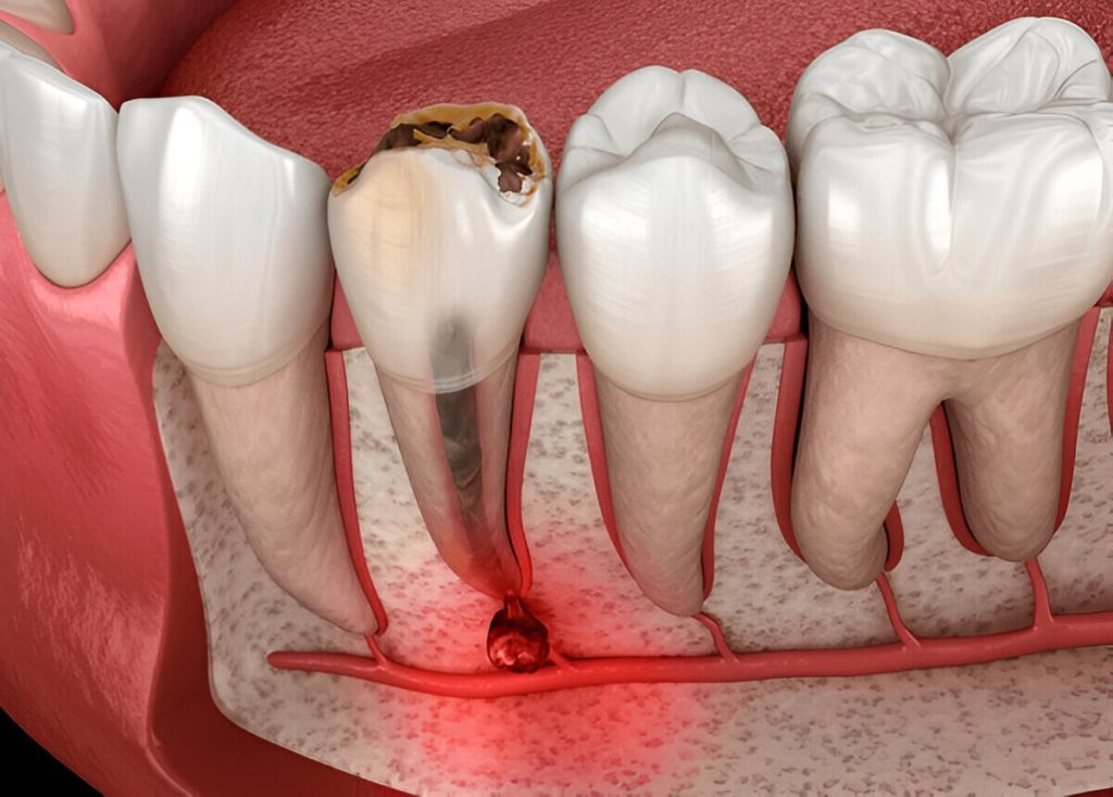 What Causes A Tooth Infection And How Can It Spread